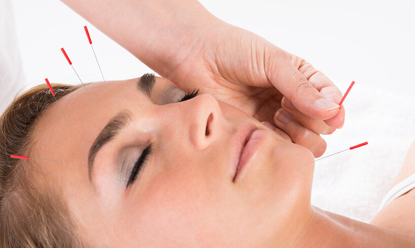 acupuncture therapy on woman face